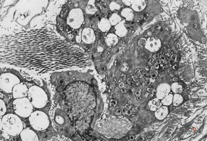 M,40y. | granular cell tumor M,40y. | granular cell tumor